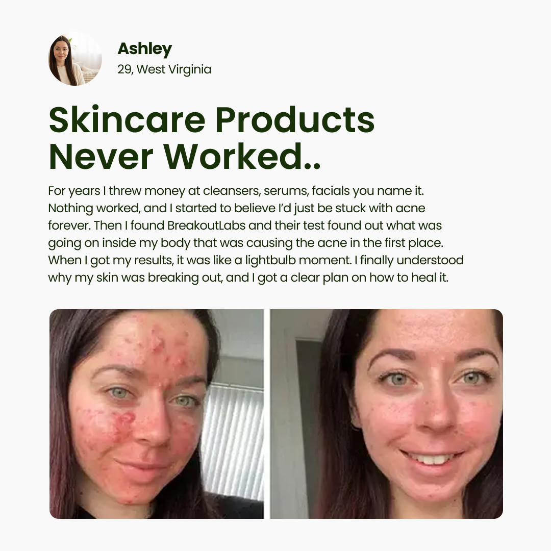 BreakoutLabs Acne Root Cause Test