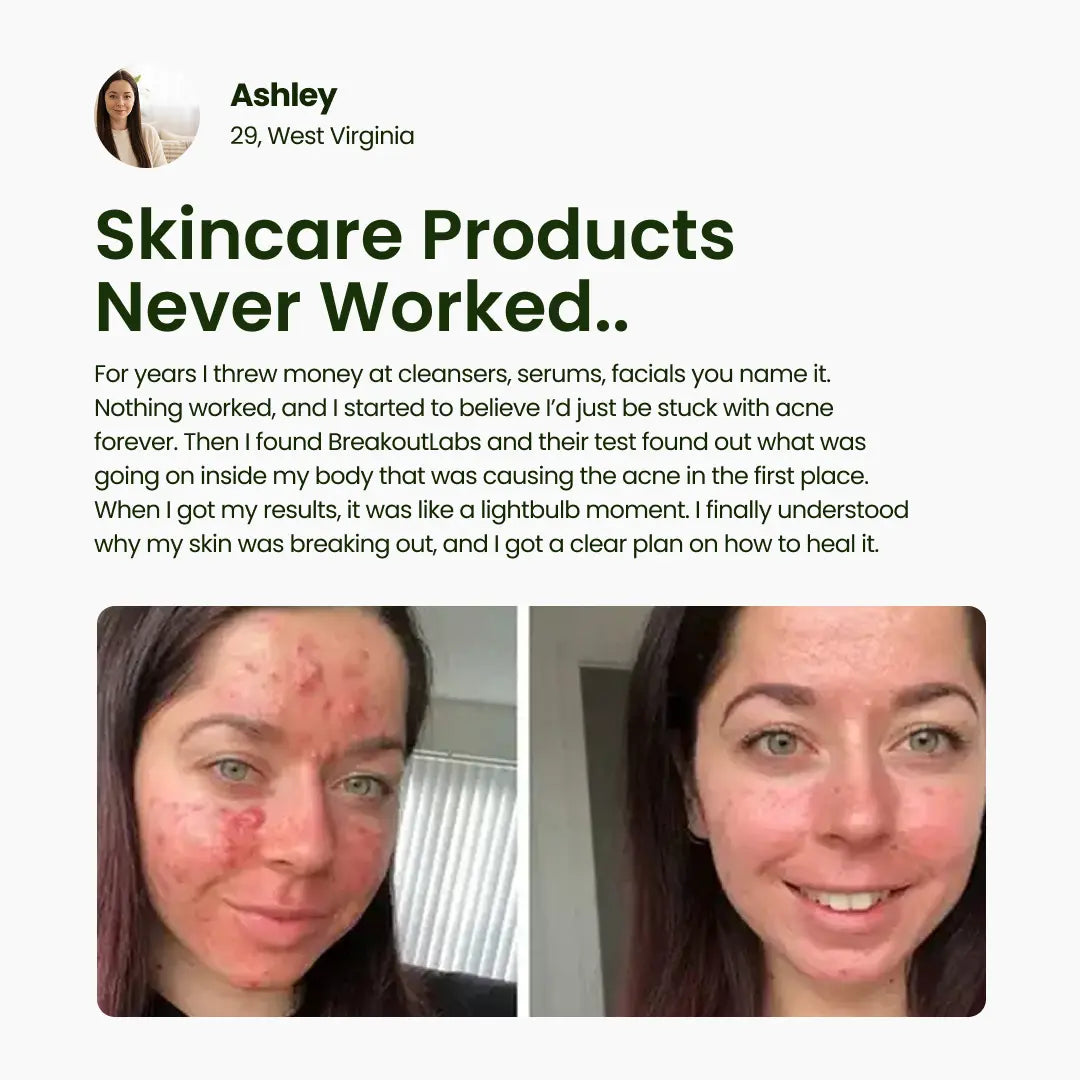 BreakoutLabs Acne Root Cause Test BreakoutLabs