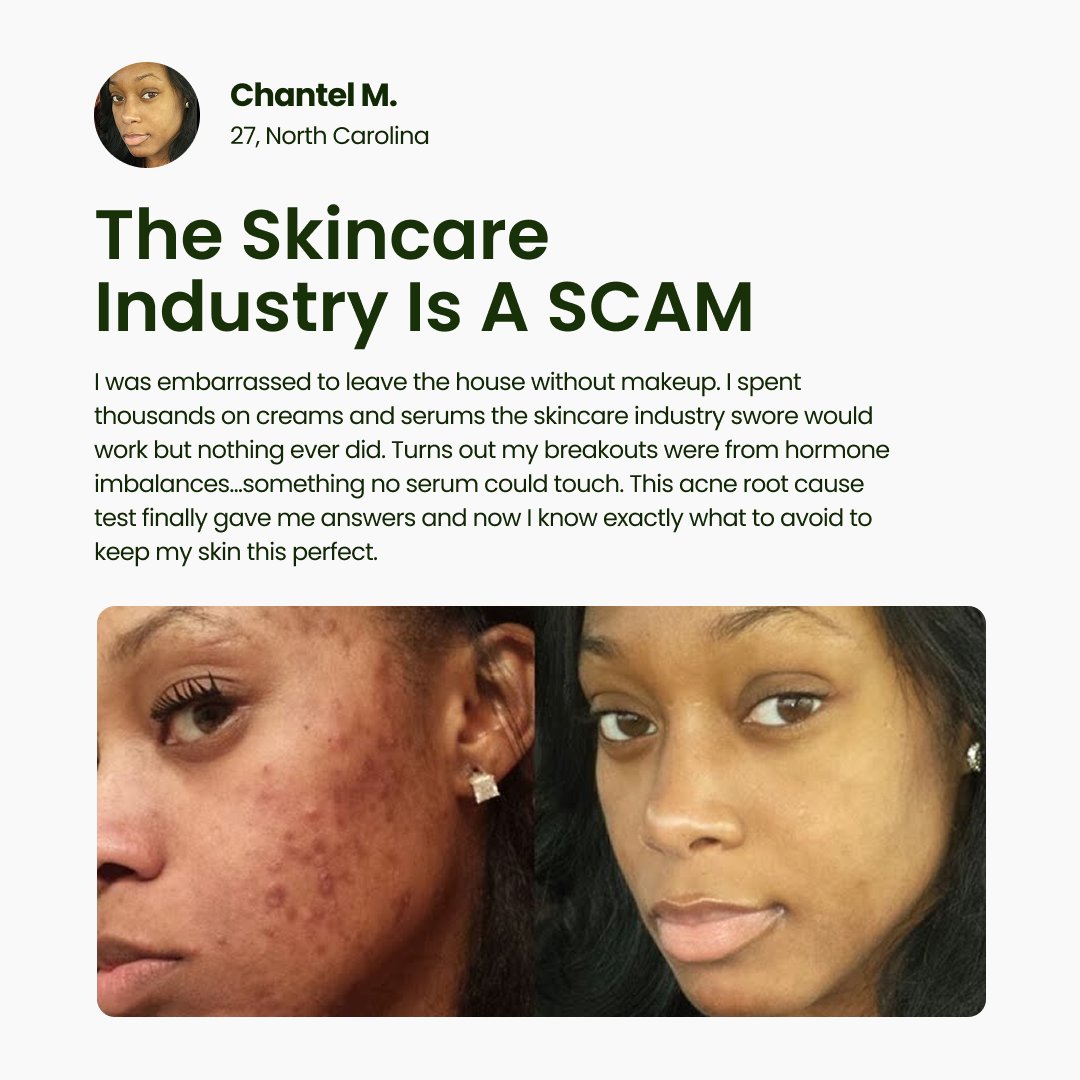 BreakoutLabs Acne Root Cause Test