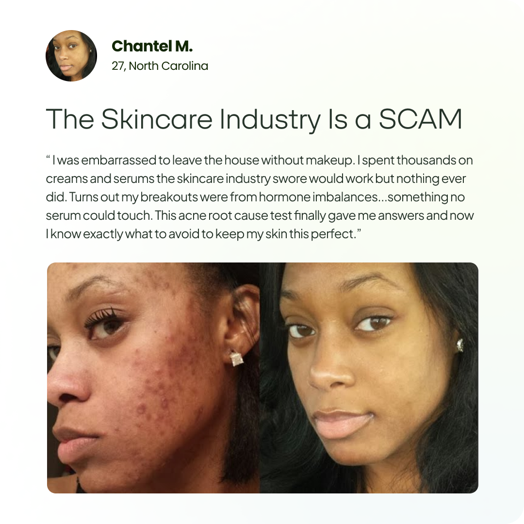 Acne Root Cause Test Kit