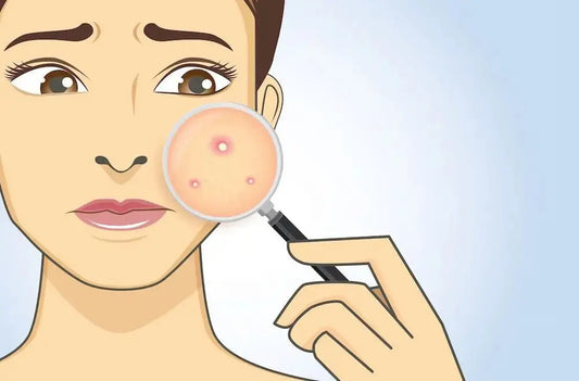 Period and Menstrual cycle acne - BreakoutLabs
