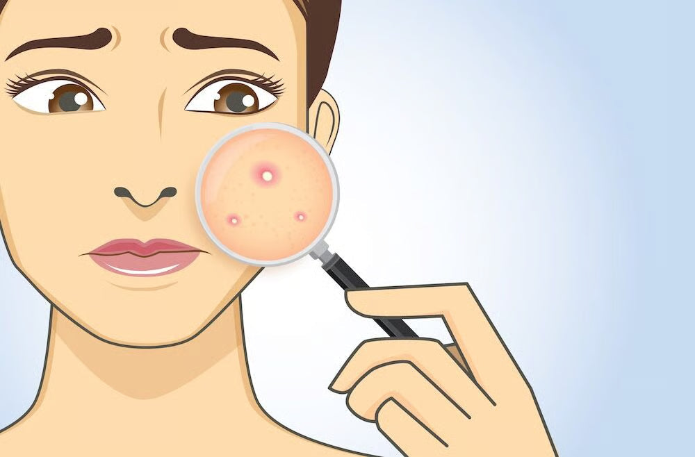Period Acne Causes, Treatments, and Cycle-Based Skincare