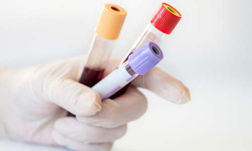 What Blood Tests Should You Get for Persistent Acne?