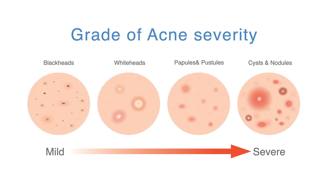 How to Cure Hormonal Cystic Acne