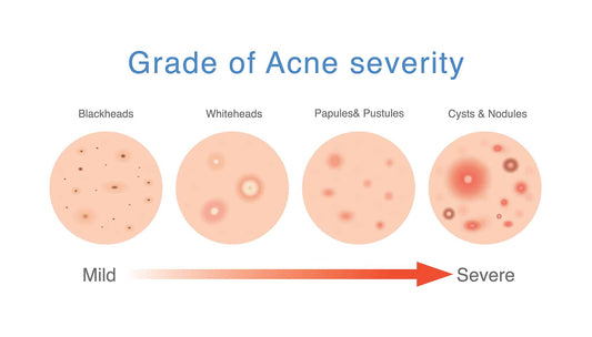 How to Cure Hormonal Cystic Acne