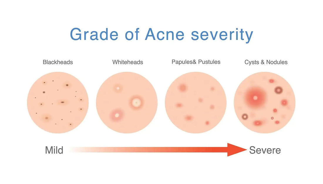 How to Cure Hormonal Acne & Cystic Acne - BreakoutLabs
