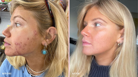 Natural Remedies for Hormonal Acne