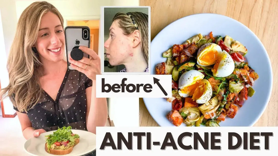 Hormonal Acne Diet - BreakoutLabs