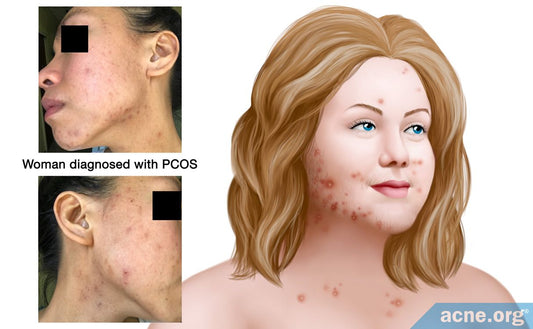PCOS and Acne: Understanding the Hormonal Link