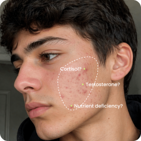 Every teen's acne has a different root cause.